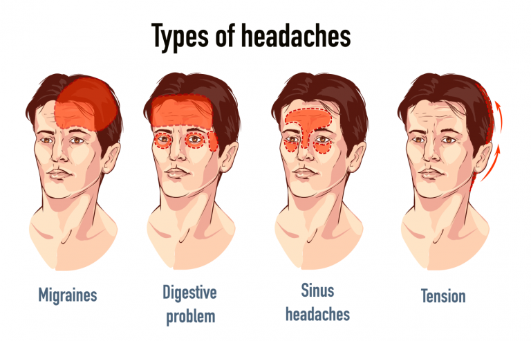 Understanding Different Types of Headaches and How Functional Neurology Can Help